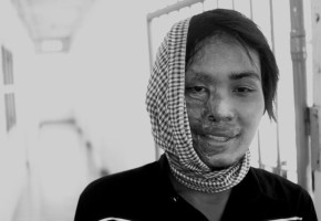 Acid Attacks Against Women Continue Acid Attacks Against Women Continue